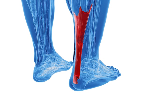 Achilles Tendinitis Treatment in the Nassau County, NY: Massapequa (Hempstead, Levittown, Wantagh, East Meadow, Merrick, North Bellmore, Roosevelt, Bellmore, South Farmingdale, North Merrick) and Sufolk County, NY: West Babylon, Lindenhurst, Copiague, North Amityville areas