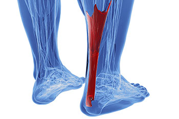 achilles tendon treatment in the Nassau County, NY: Massapequa (Hempstead, Levittown, Wantagh, East Meadow, Merrick, North Bellmore, Roosevelt, Bellmore, South Farmingdale, North Merrick) and Sufolk County, NY: West Babylon, Lindenhurst, Copiague, North Amityville areas