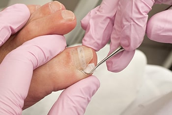 ingrown toenail treatment in the Nassau County, NY: Massapequa (Hempstead, Levittown, Wantagh, East Meadow, Merrick, North Bellmore, Roosevelt, Bellmore, South Farmingdale, North Merrick) and Sufolk County, NY: West Babylon, Lindenhurst, Copiague, North Amityville areas