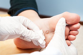 plantar warts treatment in the Nassau County, NY: Massapequa (Hempstead, Levittown, Wantagh, East Meadow, Merrick, North Bellmore, Roosevelt, Bellmore, South Farmingdale, North Merrick) and Sufolk County, NY: West Babylon, Lindenhurst, Copiague, North Amityville areas