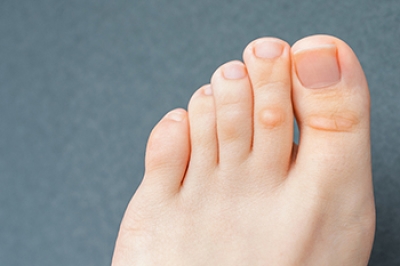 Managing Corns or Calluses