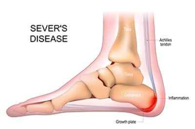 Preventing Sever’s Disease in Growing Feet