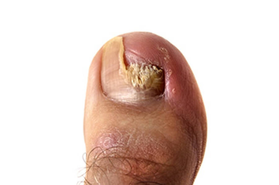 types-of-toenail-fungus