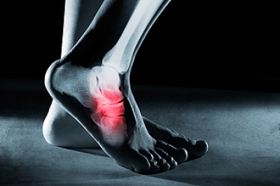 How to Diagnosis a Foot Stress Fracture