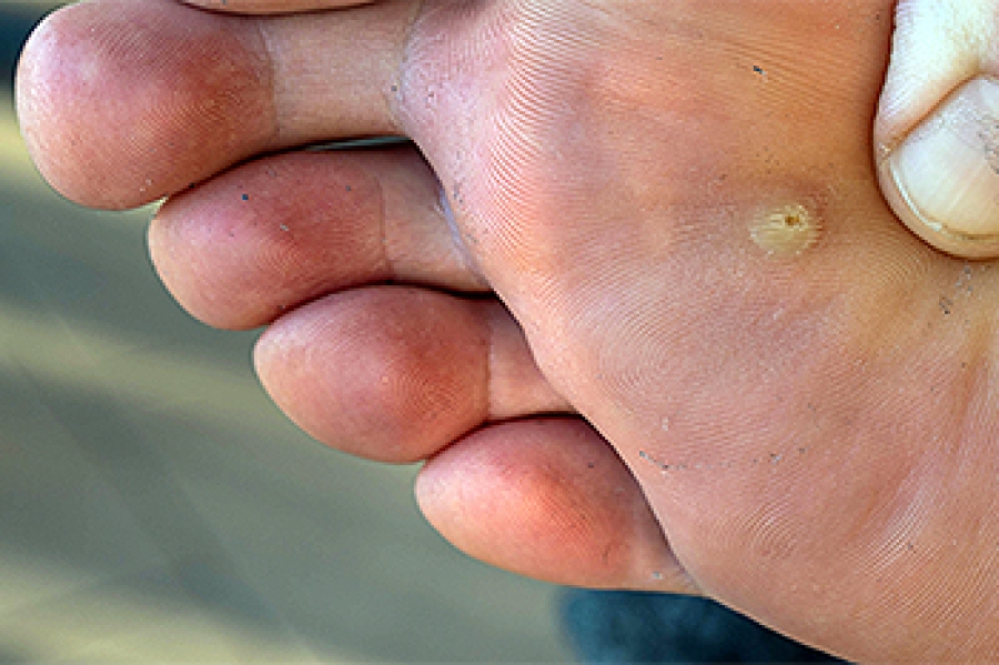 what-causes-plantar-warts